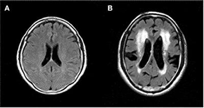 Aging Brains Degrade Driving Safety Performances of the Healthy Elderly